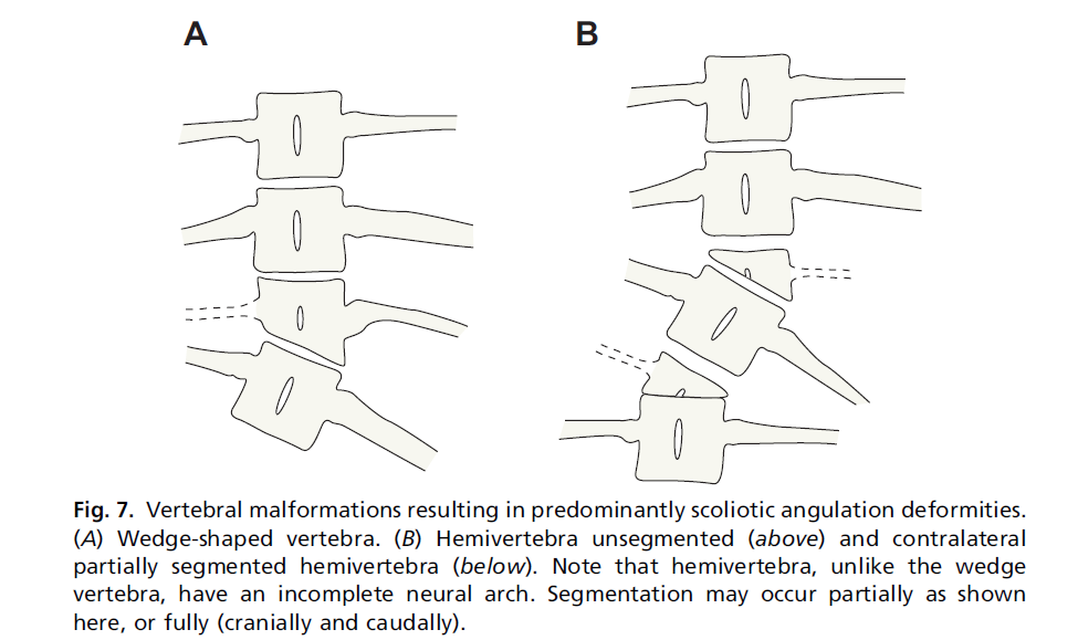 Figure 43 : Malformations vertébrales à l origine d une déformation scoliotique [65]. A : vertèbre cunéiforme.