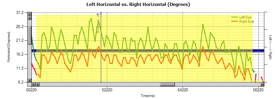 Les Fonctionnalités GazeLab Nystagmus Horizontal-regard maximum a gauche avec vibrations Oeil droit Amplitude: 5º±3º Frequency: 5±1 Hz T. Min->T.