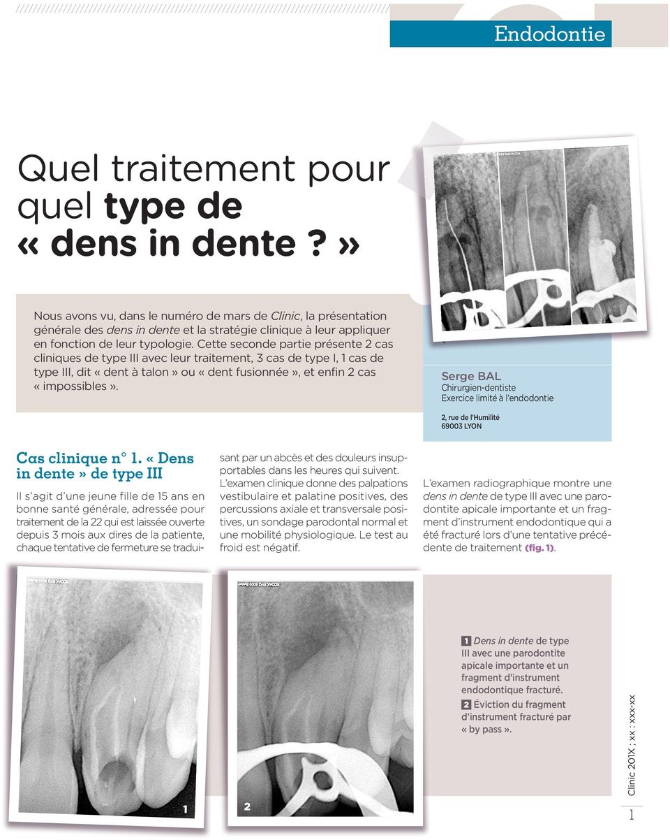 Cette seconde partie présente 2 cas cliniques de type III avec leur traitement, 3 cas de type I, 1 cas de type III, dit «dent à talon» ou «dent fusionnée», et enfin 2 cas «impossibles».