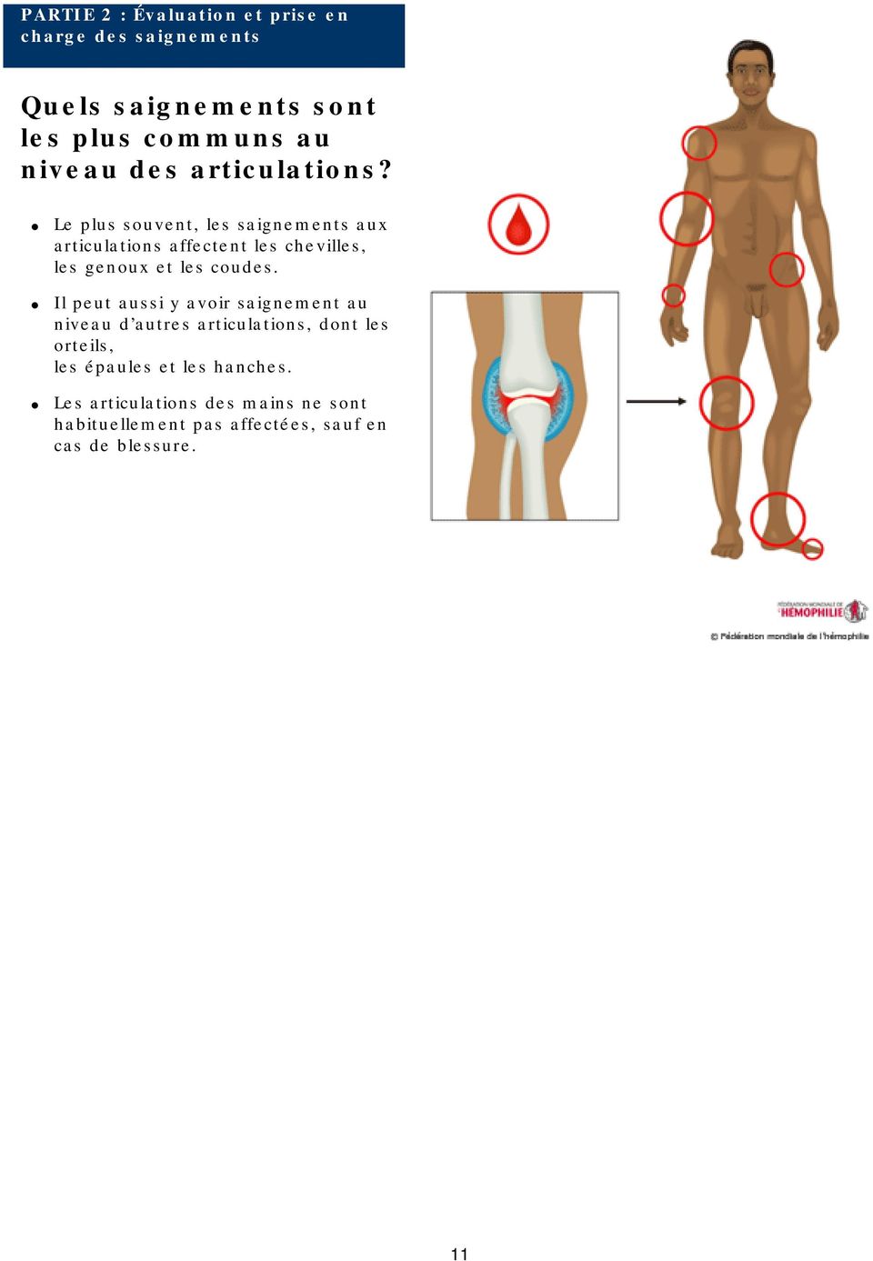 Le plus souvent, les saignements aux articulations affectent les chevilles, les genoux et les coudes.