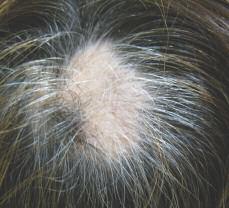 1 Absence de cheveux Une femme de 42 ans présente une zone arrondie d alopécie asymptomatique au vertex du crâne.