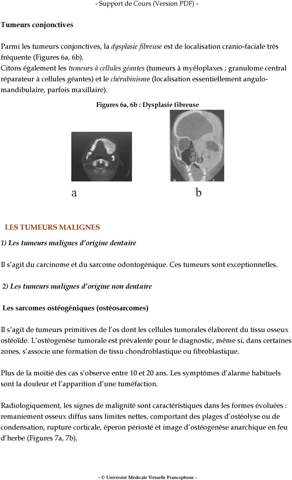 maxillaire). Figures 6a, 6b : Dysplasie fibreuse LES TUMEURS MALIGNES 1) Les tumeurs malignes d origine dentaire Il s agit du carcinome et du sarcome odontogénique. Ces tumeurs sont exceptionnelles.