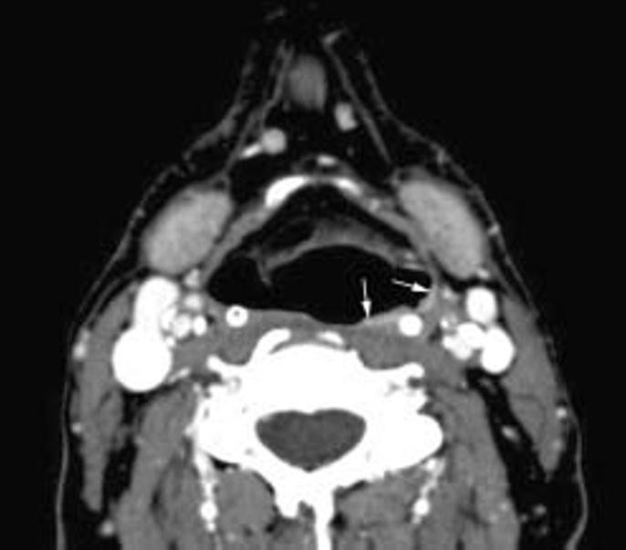 F Dubrulle et al. Larynx et hypopharynx 1007 c Fig. 15 : Tumeur infiltrante de la corde vocale gauche. a Érosion du cartilage thyroïde en regard de la commissure antérieure.