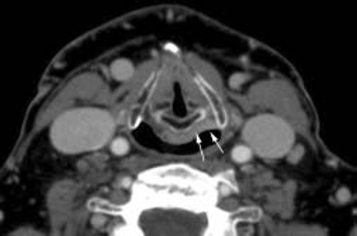 1008 Larynx et hypopharynx F Dubrulle et al. Fig. 18 : Volumineuse tumeur du sinus piriforme droit avec extension en région rétro-crico-aryténoïdienne (flèche blanche courte).
