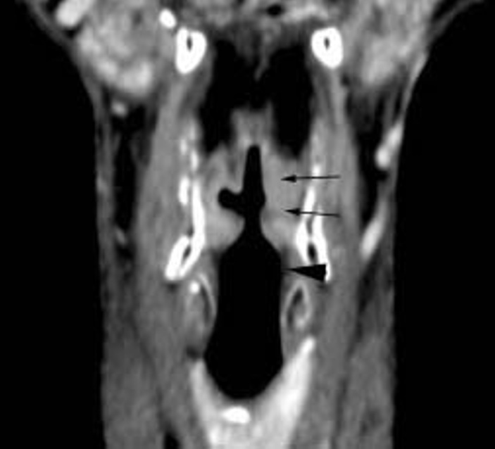 1002 Larynx et hypopharynx F Dubrulle et al. Fig. 3 : a b Tumeur sus-glottique gauche atteignant la bande ventriculaire. Extension en profondeur à l espace paralaryngé (tête de flèche).