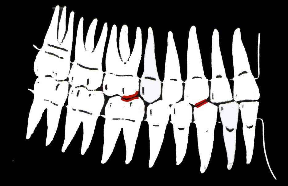 Engrènement des dents 2- occlusion encastrante chaque dent sup.