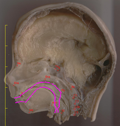 L'objectif de notre étude consiste en la description biométrique de la croissance crânio-vertébrale du fœtus et de l'enfant pour déterminer un profil ontogénique dans toute sa continuité.