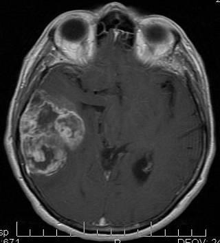La Néoangio-génèse 1 2 Femme,59ans, traitée pour un astrocytome agressif IRM axiale avec PdC. 1.Diagnostic P.