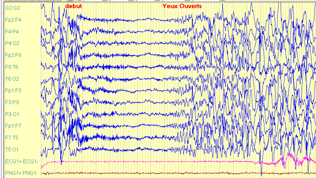 EEG pendant la crise