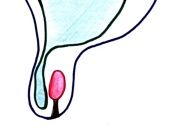 M 7 cavité péritonéale cavité vaginale