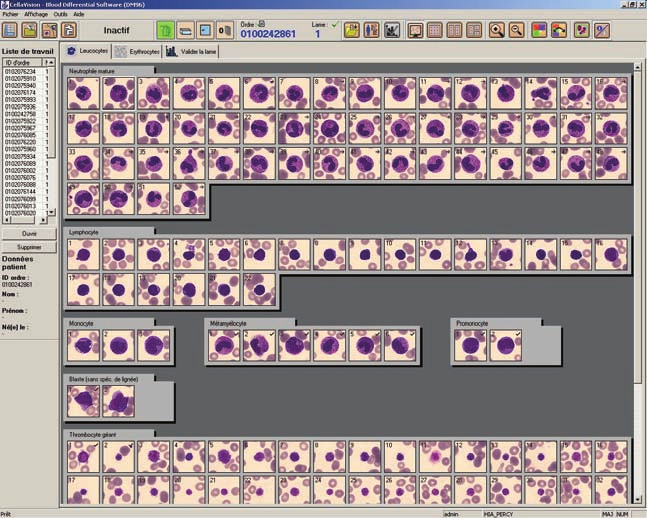 Analyse d image en cytologie hématologique Tableau 4. Échantillons de sujets en aplasie (< 1 G/L) - nombre d événements bruts et de leucocytes réels photographiés par le DM96 TM.
