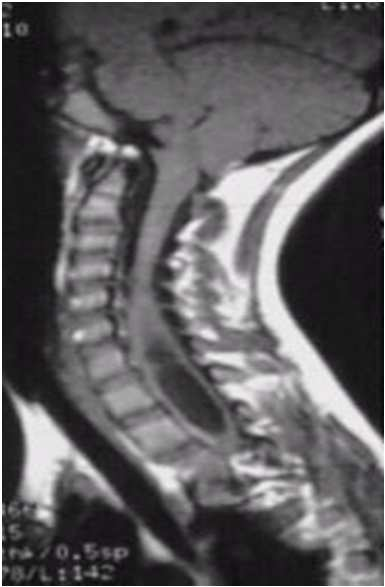 La syringomyélie: cavité intrmédulaire Le spina bifida :malformation de l