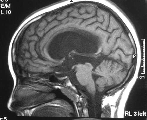 Figure 8 : Coupe IRM sagittale médiane de l encéphale Figure 9 : Coupe IRM sagittale médiane de l encéphalemontrant une hydrocéphalie Question 3 : Est ce que mésencéphale = pédoncule cérébral?