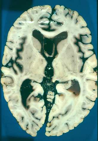 Figure 23 : Coupe transversale du cerveau Figure 24 : Coupe