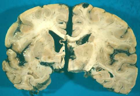 Figure 27 : Coupe frontale d un cerveau passant par le tronc cérébral Question 48 : Quel est le rôle des noyaux caudés et des noyaux lenticulaires?