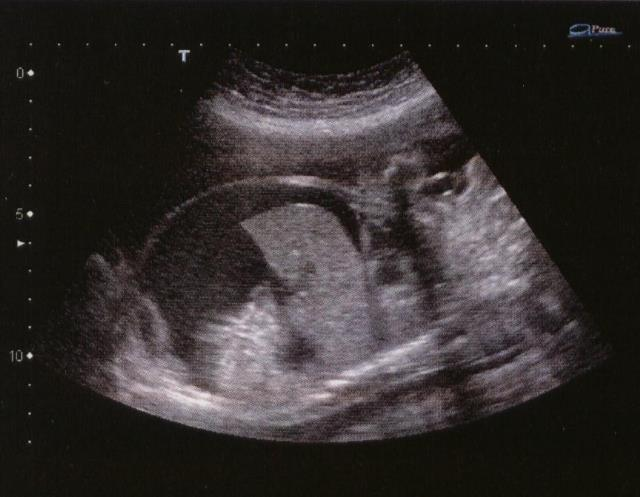 Echographie fœtale Anasarque fœto-placentaire Signe beaucoup trop tardif d anémie fœtale sévère et
