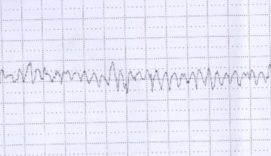 Enregistrement du rythme cardiaque fœtal (RCF) Très spécifique Peu spécifique Tracé rare Signe