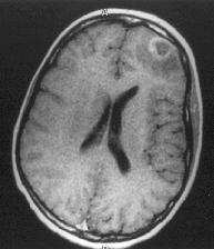 Acido-cétose et œdème cérébral (1) Rare (<1%) mais grave Complication du traitement Marcin et al.