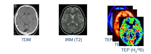 - Imagerie fonctionnelle ou moléculaire : on parle d imagerie fonctionnelle par opposition a l imagerie anatomique, ci-dessous on a la représentation du cerveau par 3 approches différentes.