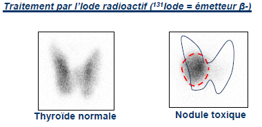 Une autre option est d utiliser l iode en tant qu émetteur de rayon particulaire en effet dans certains cas pathologique tel qu une hyperthyroïdie ou d un nodule toxique ( c'est-à-dire une zone de la