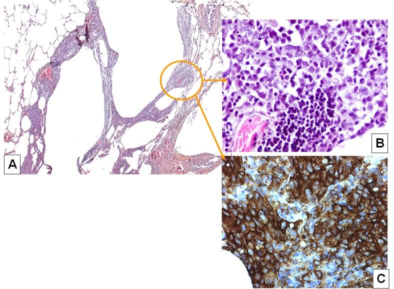 ana-path A : histiocytose langerhansienne pulmonaire au stade de kystes renfermant un infiltrat cellulaire au sein de leur paroi B : fort grossissement: prolifération de cellules de langerhans