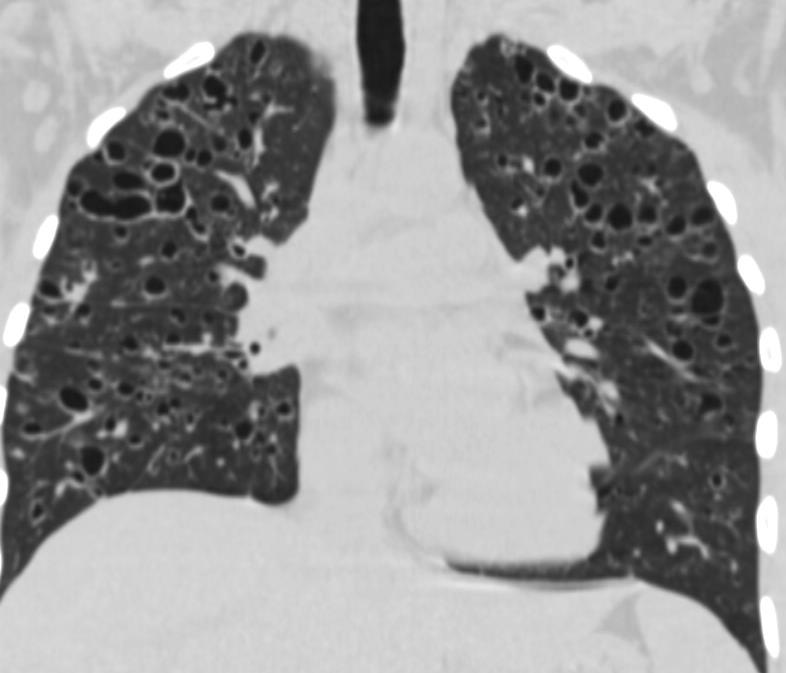 au total l'histiocytose primitive pulmonaire à cellules de Langerhans est en règle assez facile à diagnostiquer en raison du contexte de tabagisme intense présent dans plus de 90 % des cas et du