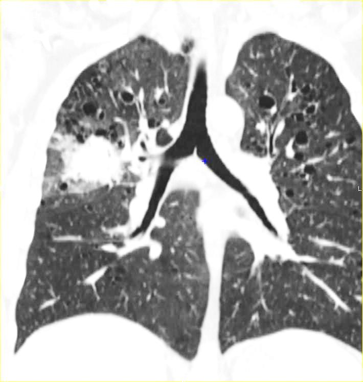 -au scanner, la masse pulmonaire révèle ses contours spiculés ainsi que la présence de lacunes