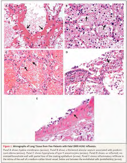 Pandémie A(H1N1)pdm09 5 cas autopsiques Lésions aspécifiques : - Membranes hyalines - Œdème alvéolaire septal - Hyperplasie des pneumocystes II -