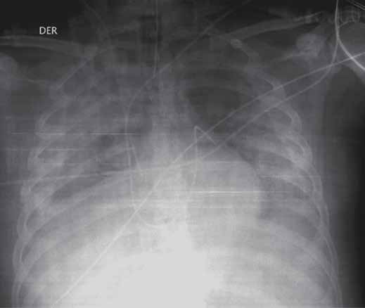 Syndrome pulmonaire à Hantavirus Cornejo