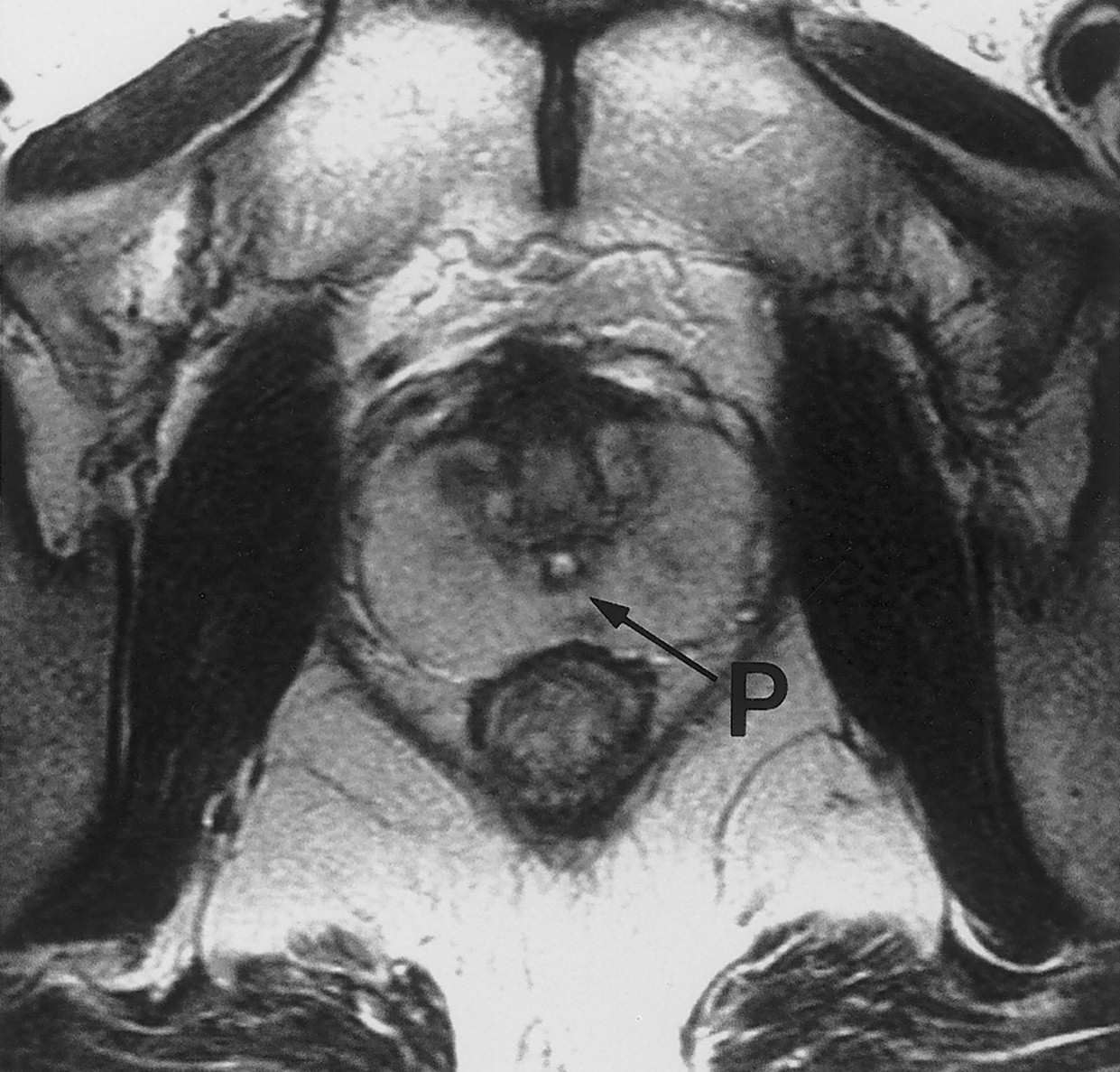Urètre prostatique Urètre supramontanale Épithélium transitionnel de type vésical