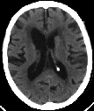 AVC : Imagerie cérébrale: IRM Séquence de diffusion (DWI): ischémie récente }