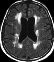 AVC - Imagerie cérébrale: IRM Séquence FLAIR