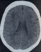 AVC - Imagerie cérébrale: IRM Séquence FLAIR Lésions