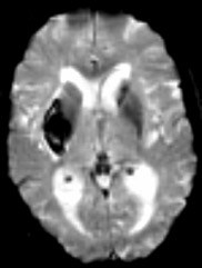 AVC - Imagerie cérébrale: IRM Séquence T2* écho de gradient } Sensible aux