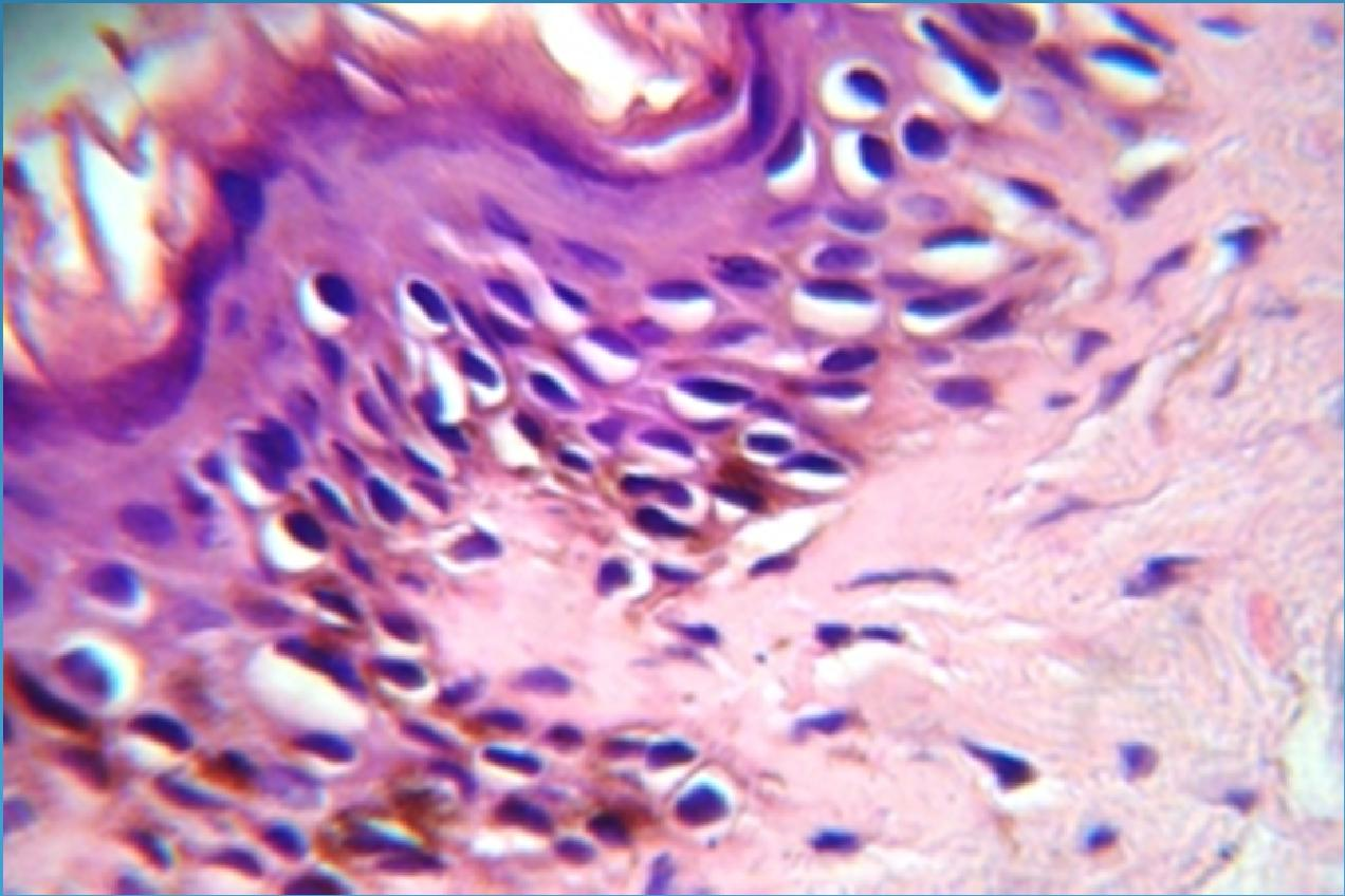 Histologie : - Un épiderme atrophique irrégulier avec présence de zones d hyperpigmentation - Une vacuolisation de la membrane basale par