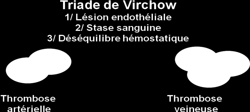 Elle survient le plus souvent à la suite d une triade de Virchow : Thrombose artérielle : surtout 1 et 3 Thrombose veineuse : surtout 2 THROMBOSES Interaction anormale Sang / paroi