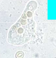 Sur cette image de microscopie, on peut voir la forme histolytica : grosse cellule qui émet des pseudopodes pour phagocyter les GR.