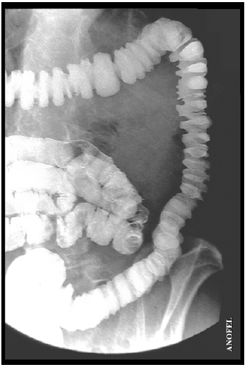 Image de lavement baryté avec un aspect du colon en «piles d assiettes»,illustrant bien les contractions très douloureuses Du fait de cette stimulation des terminaisons nerveuses intestinales, on