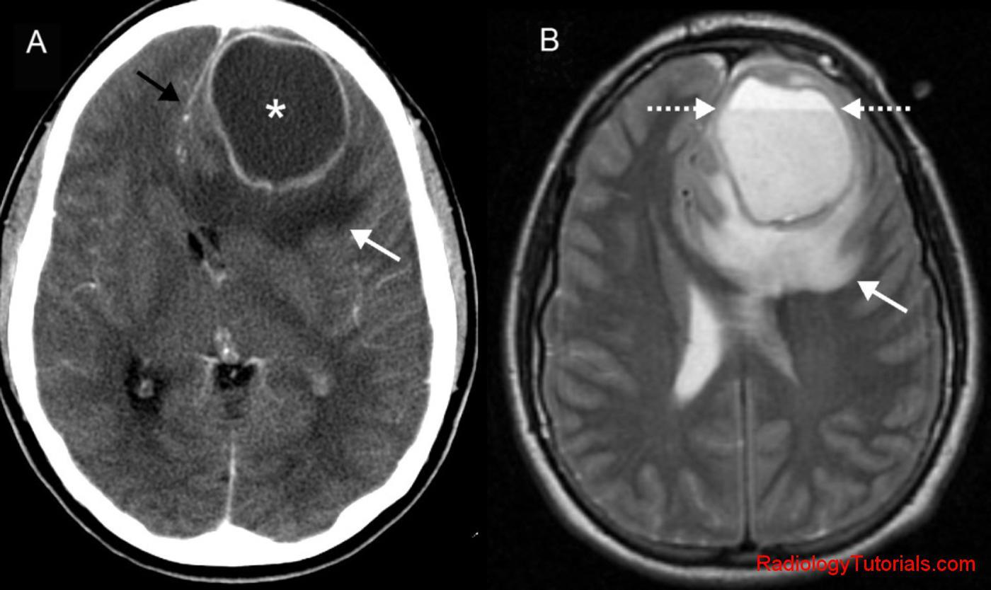 Abcès cérébral frontal gauche avec œdème perilesionnel (flèche) et effet de