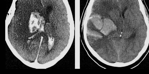 Dense haematoma > 30% of the infarcted area with substantial space-occupying effect, or any haemorrhagic lesion outside the infarcted area ECASS Hacke W, Kaste M, Fieschi C, et