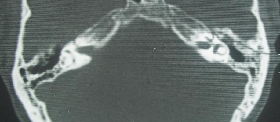 TDM en coupe axiale: Fracture longitudinale du Rocher