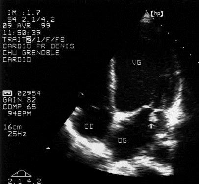 Examens para-cliniques majeurs Echographie cardiaque transœsofagienne ETO Végétation État valves cardiaques Fonction ventriculaire gauche HTAP Hémocultures 3 paires