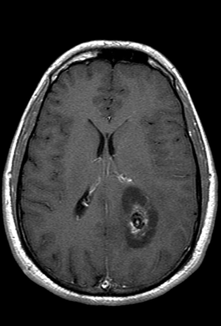 Neurocytome extraventriculaire Lésion