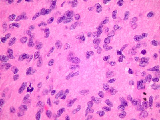 Astrocytome III Lanaplasie focale/diffuse Mitoses Si BST: 1 mitose et Ki67 élévé >10% Absence de PEC Absence de nécrose difficile à cerner en pratique Périphérie de GBM Stade
