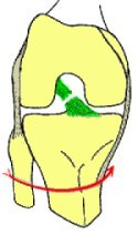 Le ligament croisé antérieur (LCA) est un des 4 ligaments du genou.