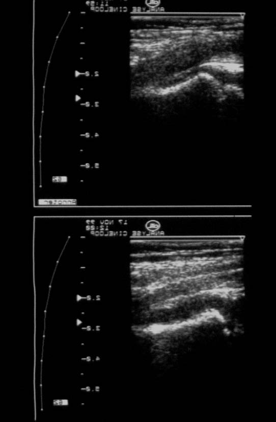 Les infections de la hanche de l enfant Figure 3. Hanche droite détruite par une ostéoarthrite néonatale. Il faut penser à examiner les tympans à la recherche d une otite.