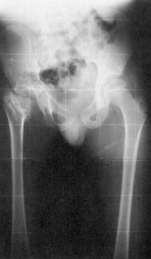 Toute boiterie de hanche fébrile doit faire évoquer une arthrite septique [4].