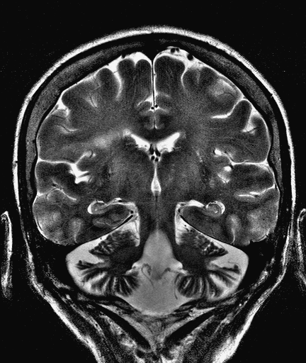 Femme âgée de 65 ans; épilepsie depuis l enfance; foyer EEG frontal droit.
