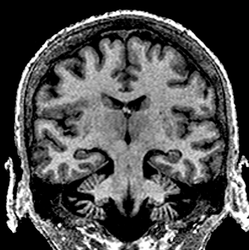Epaississement du ruban cortical frontal operculaire droit avec un aspect