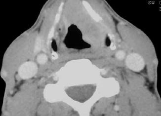 RESULTATS Carcinome épidermoïde du larynx